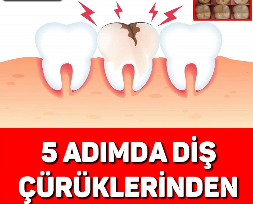 5 ADIMDA DİŞ ÇÜRÜKLERİNDEN KURTULUN - 1