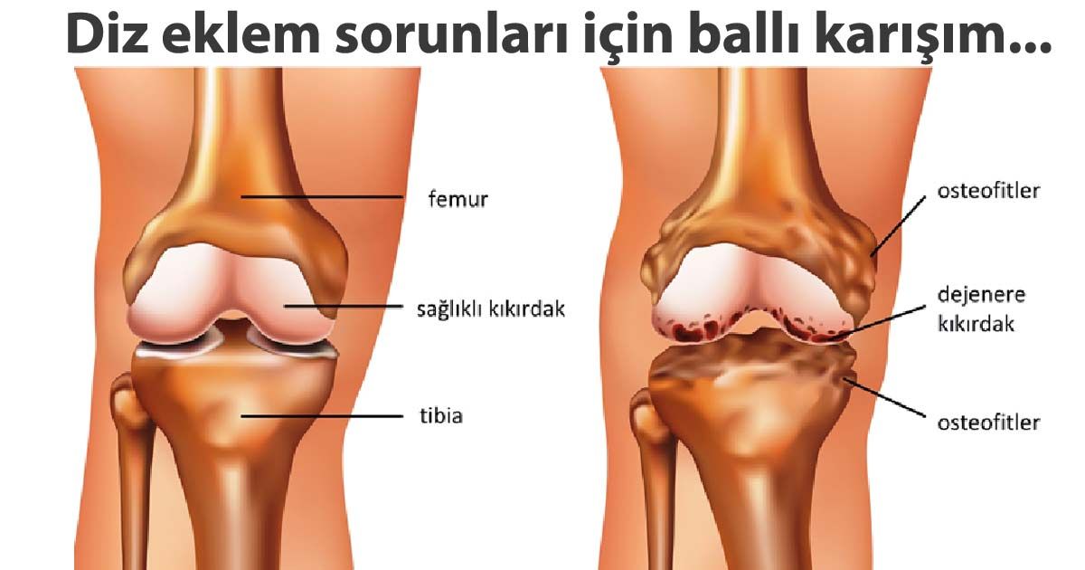 Diz Ağrılarınızı Bitiren Karışım - 1