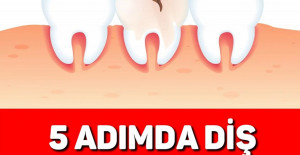 5 ADIMDA DİŞ ÇÜRÜKLERİNDEN KURTULUN