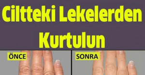 Ünlü Dermatoloji Uzmanın Tarifi İle Ciltteki Lekelerden Kurtulun