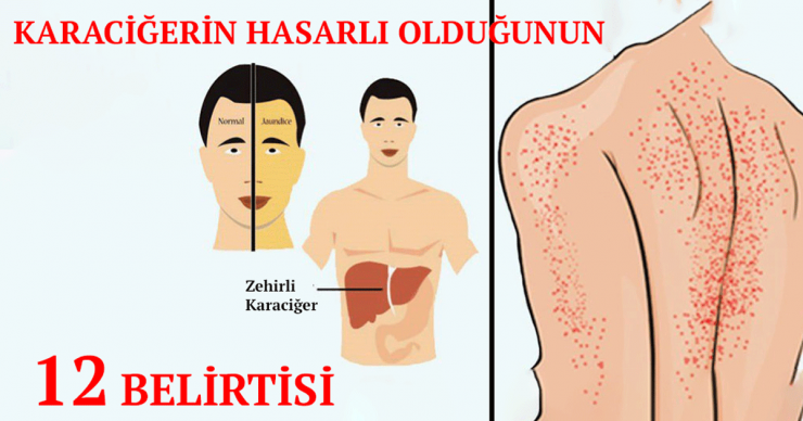 Karaciğerin Çalışmadığına Gösteren 12 Belirti - 4